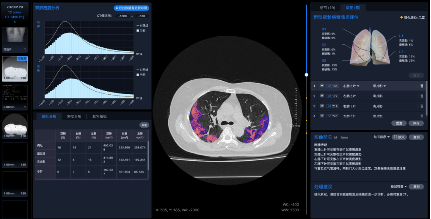 医疗AI助力佛山市第一人民医院智慧战疫